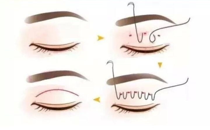 鄭州割雙眼皮十佳醫生名單！哪些醫生綜合實力更強？